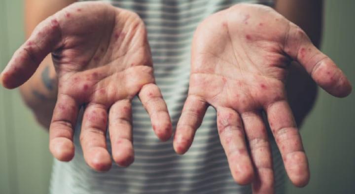 Argentina registra nuevos casos de sarampión en personas no vacunadas